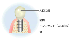 インプラント治療