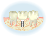 「インプラント」の治療法