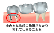 「ブリッジ」を用いた従来の治療法