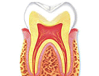 歯の神経を残す『歯髄回復治療』