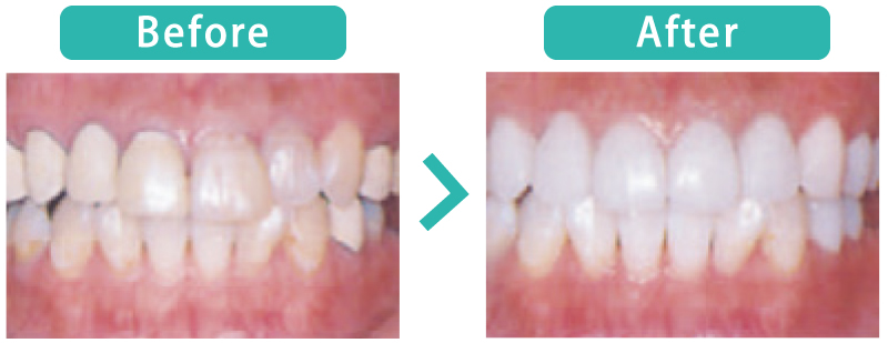 口腔リフォームの治療前と治療後