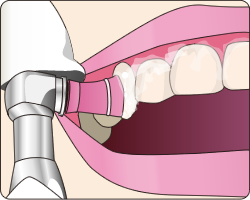 歯の表面をクリーニング